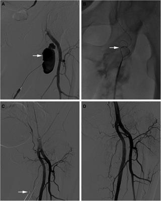 Frontiers Case Report Successful And Effective Percutaneous Closure Of A Deep Femoral Artery